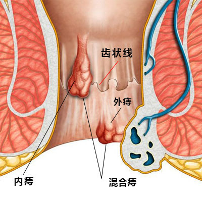 痔疮.jpg