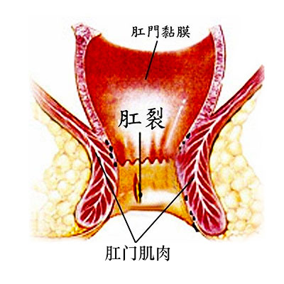 肛裂4.jpg